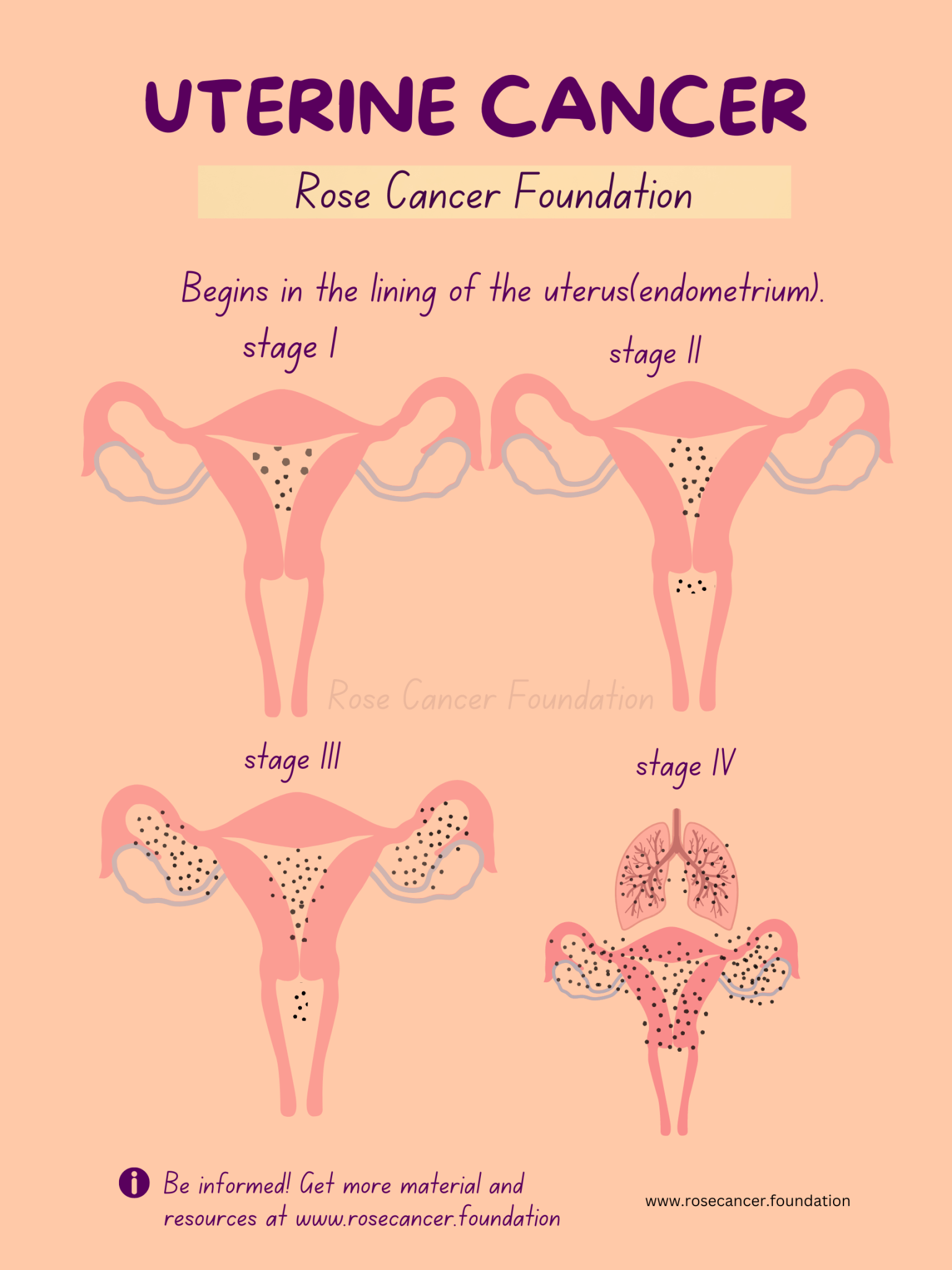 Uterine Endometrial Cancer